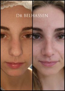Rhinoplastie-Dr-Belhassen