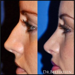 Rhinoplastie-