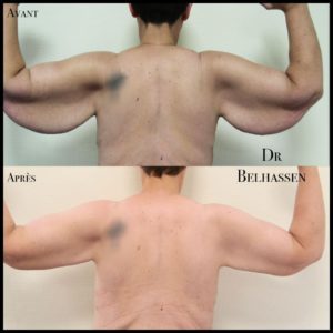 Lifting des cuisses -Dr Belhassen