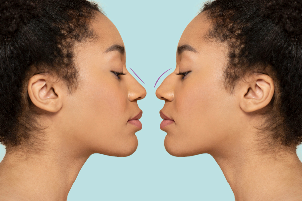 La Rhinoplastie : Tout un Art