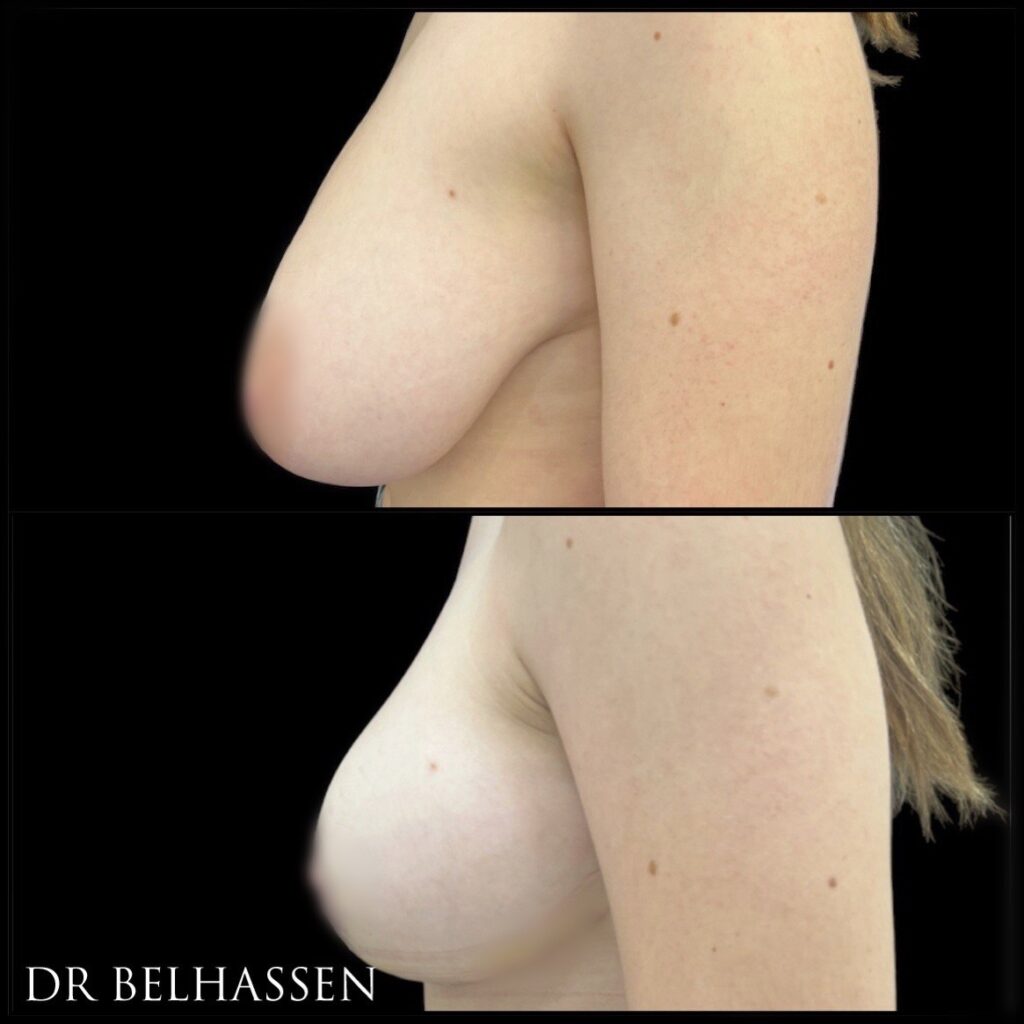 avant apres resultat ptose mammaire cure de ptose sein tombant dr belhassen nice cannes